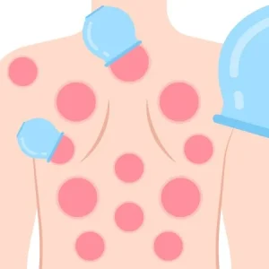 Hijama: 8 Avantages Incroyables pour Votre Santé et Bien-Être 2 Hijama